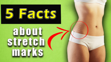 5 Facts About Miracle Products Realistic Expectations for Stretch Marks