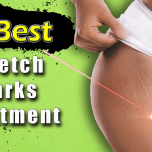 Cosmetic surgery for stretch marks