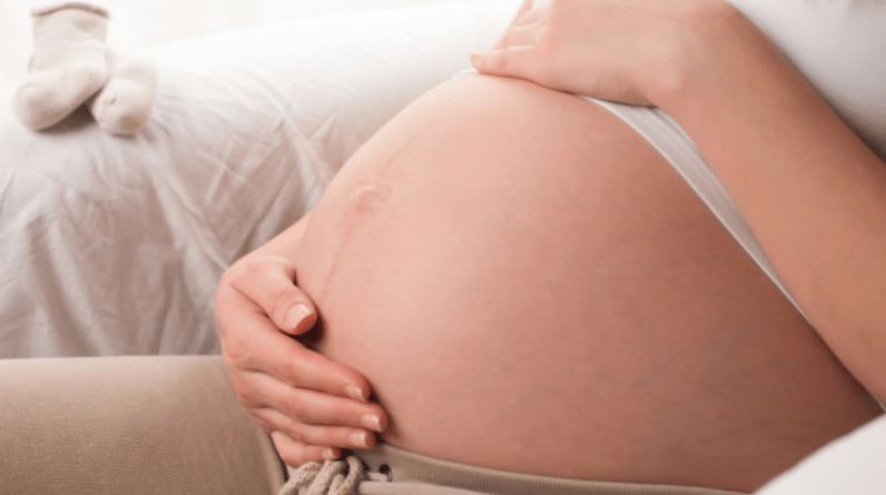Stretch Marks in Pregnancy