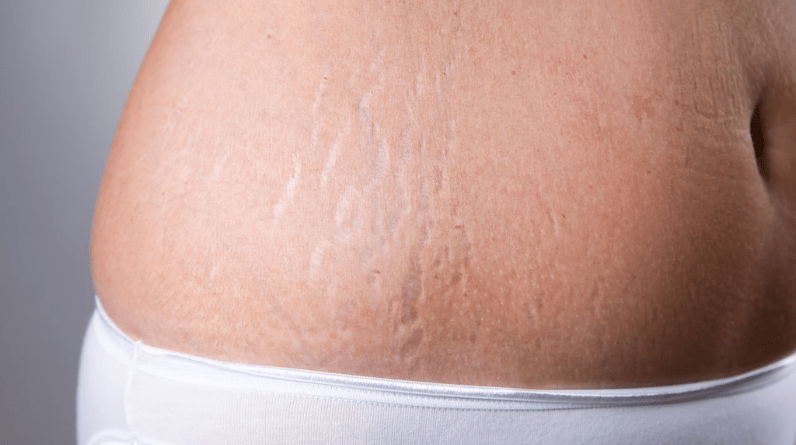 Unlocking the Secret: How to Remove Stretch Marks Permanently at Home 3