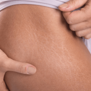 why stretch marks are red