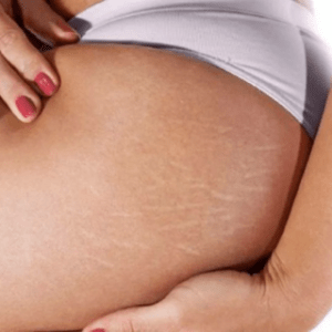 Will Stretch Marks Ever Go Away? Understanding the Possibilities and Solutions 18