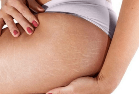 Will Stretch Marks Ever Go Away? Understanding the Possibilities and Solutions 25